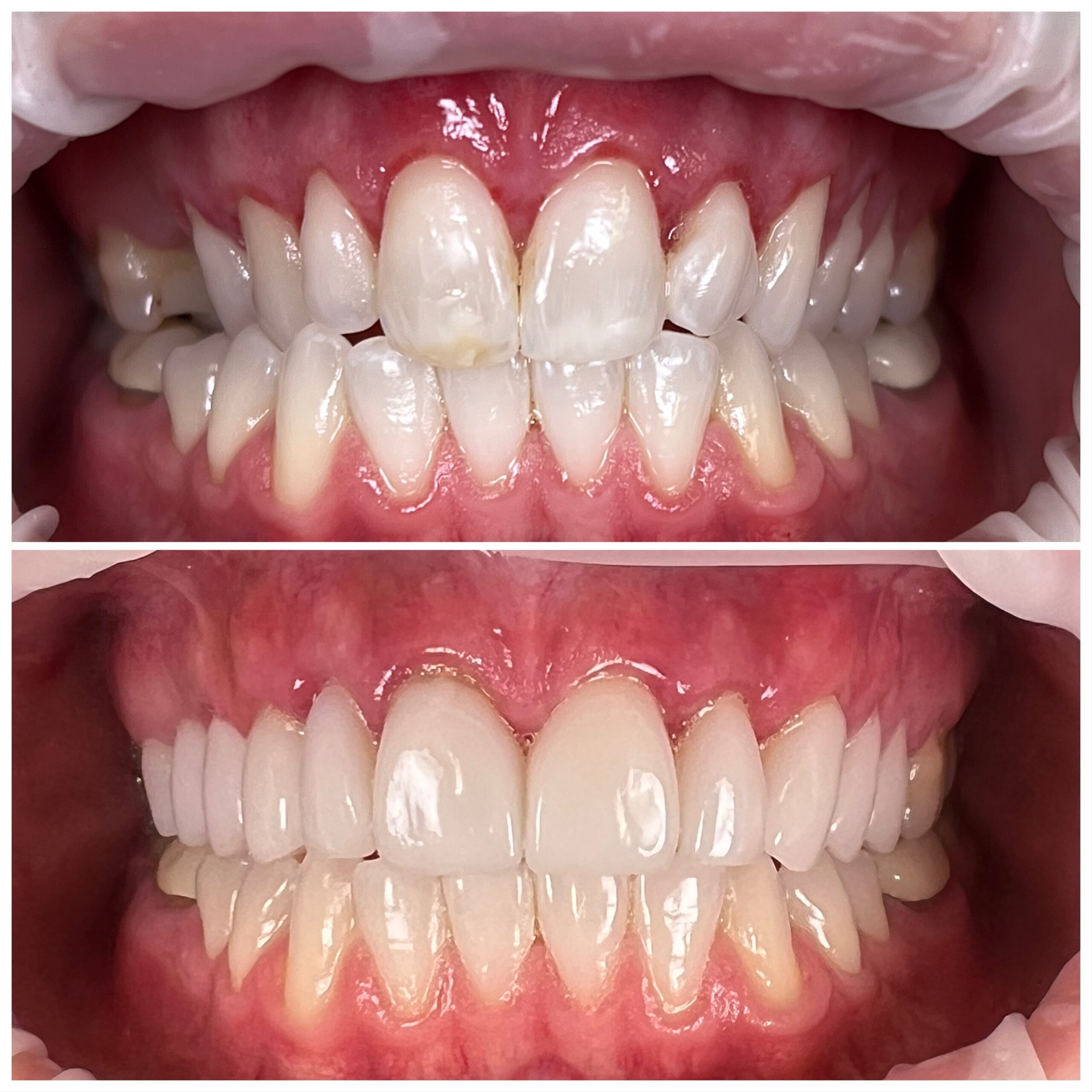 Teeth Comparison After Treatment - North Barrie Dental