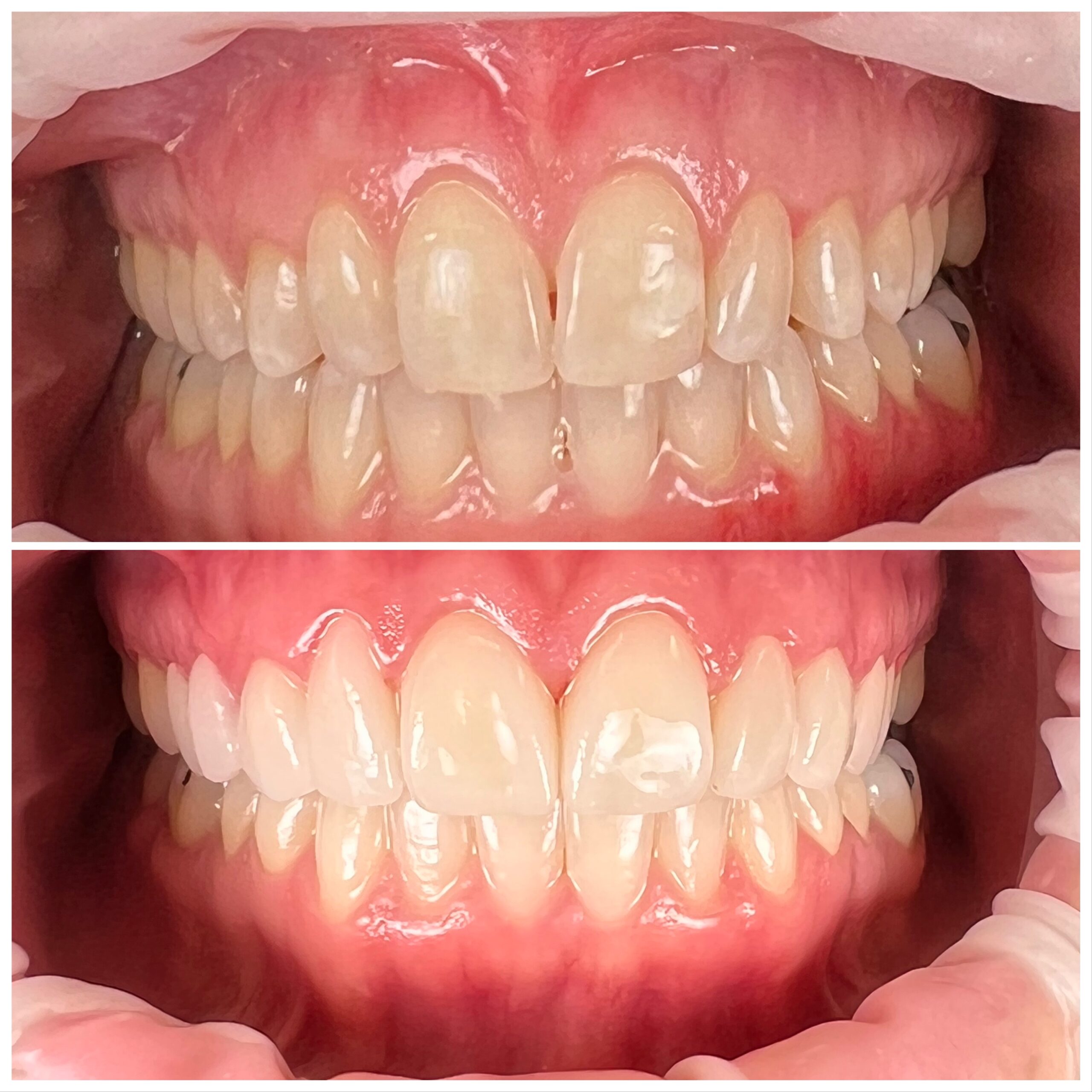 Teeth Comparison After Treatment - North Barrie Dental