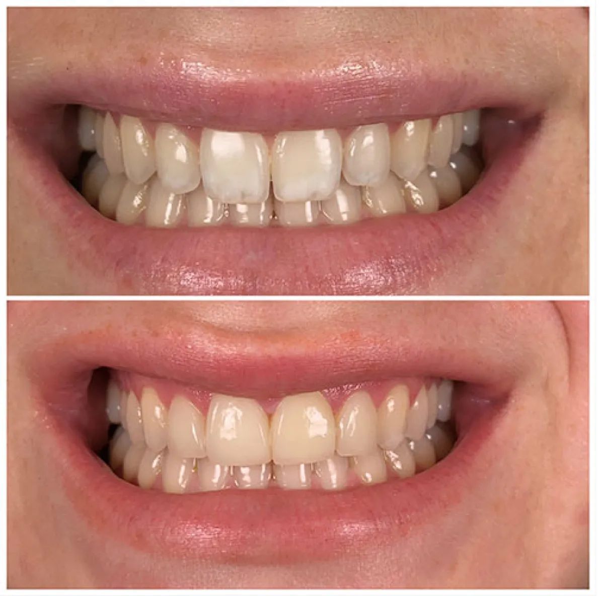 Teeth Comparison After Treatment - North Barrie Dental