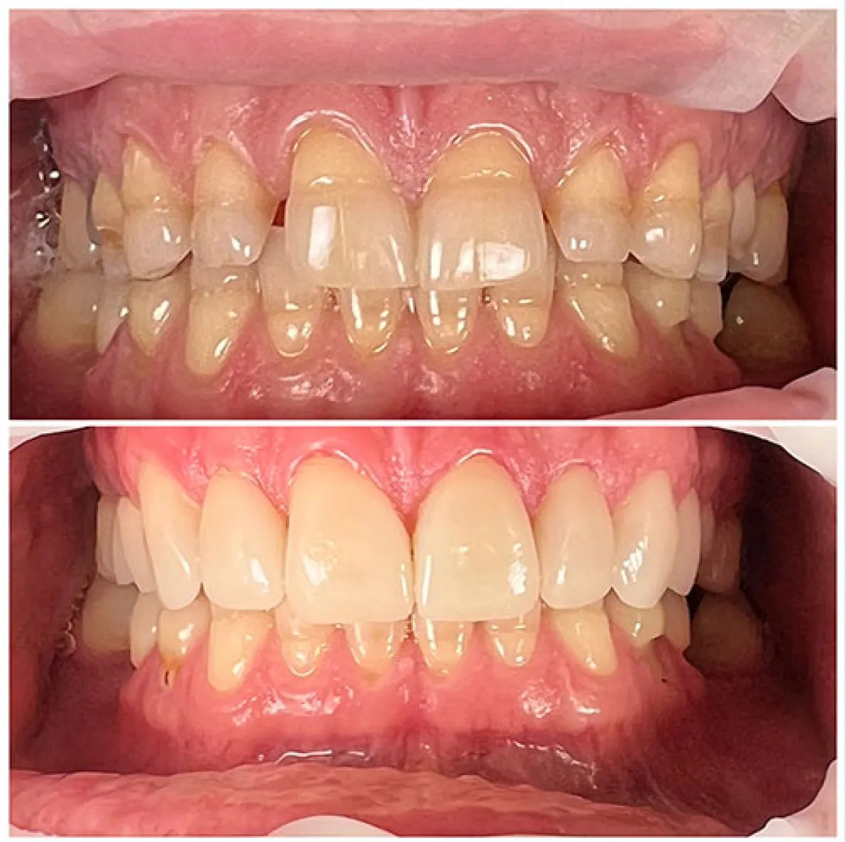 Teeth Comparison After Treatment - North Barrie Dental