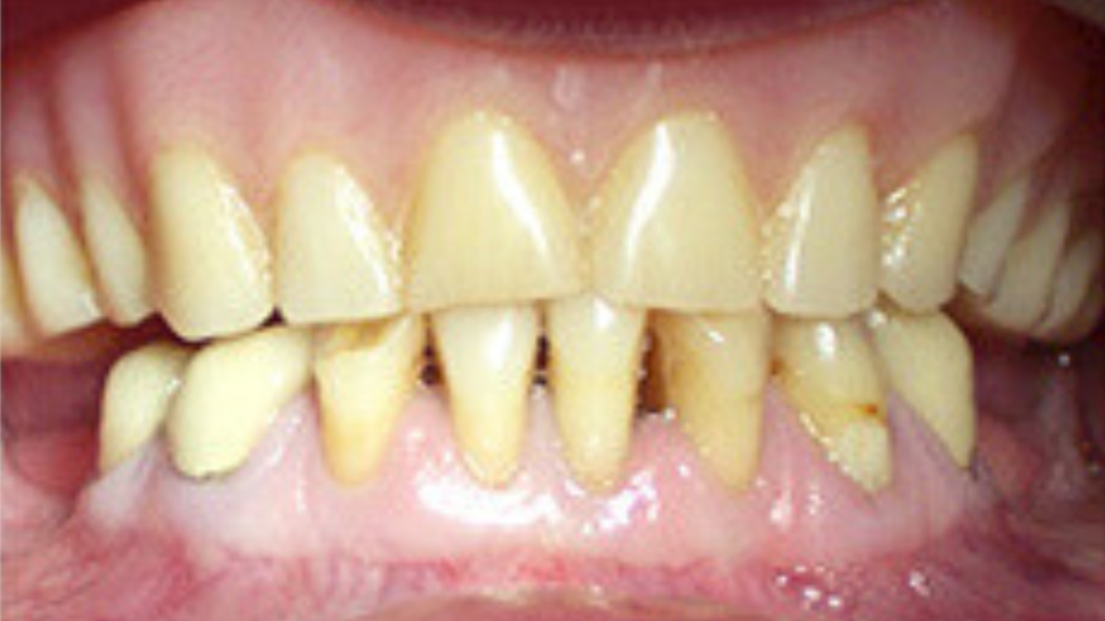 Defective Teeth - North Barrie Dental