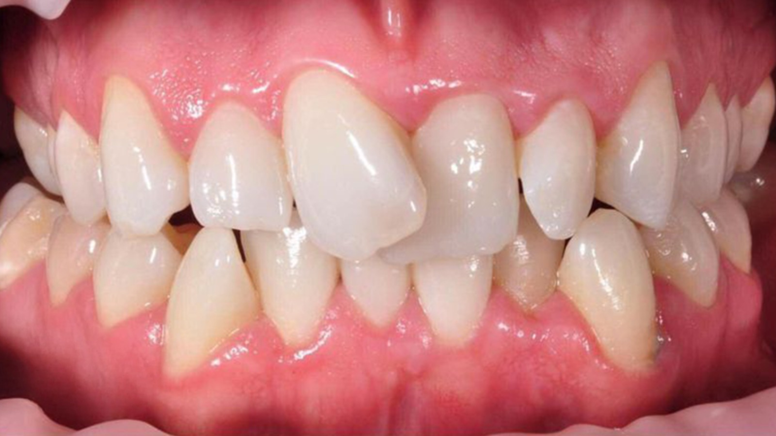 Defective Teeth - North Barrie Dental