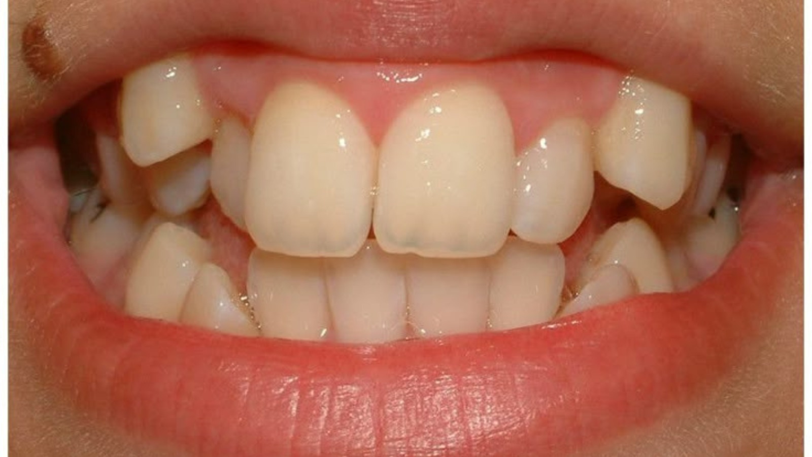 Defective Teeth - North Barrie Dental