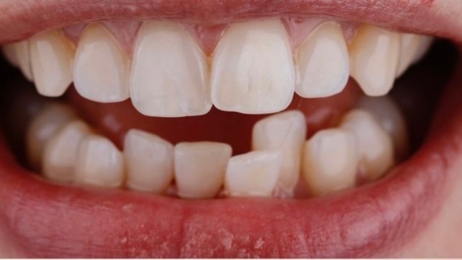 Defective Teeth - North Barrie Dental