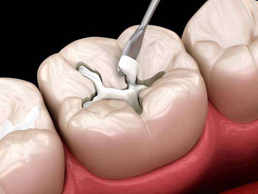 Decayed Tooth Restoration With Composite Filling Dental 3D Illustration – North Barrie Dental