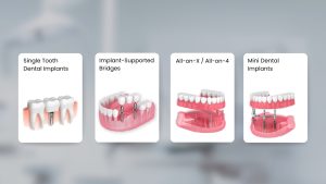 Dental Implants