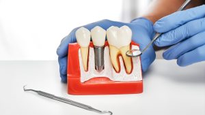 Dental Implants